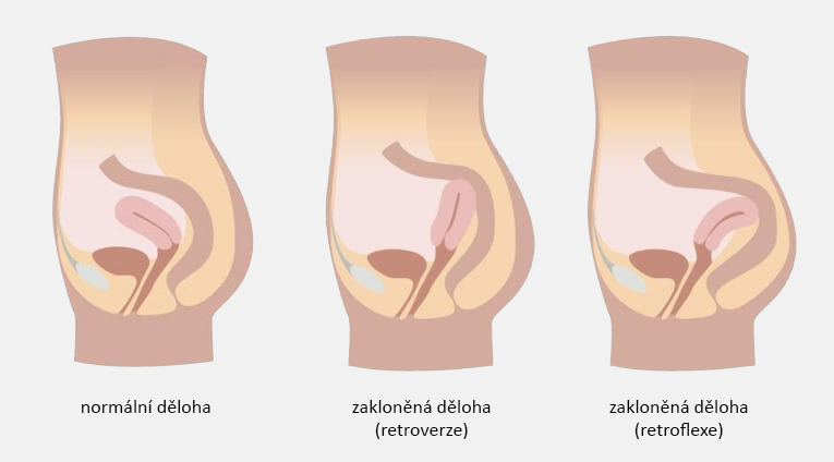 popis zaklonena deloha